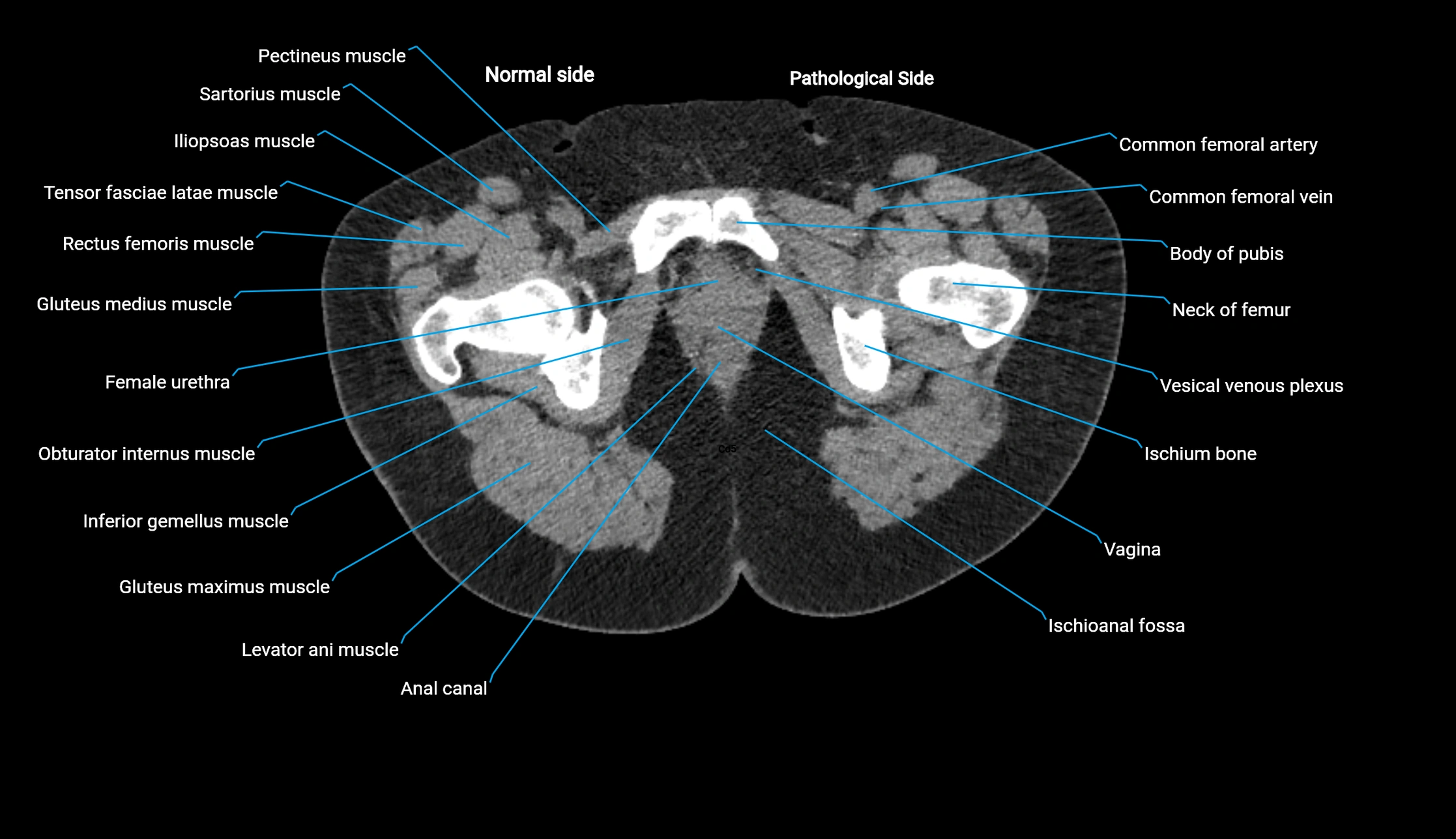 CT KUB axial cross sectional anatomy  radiology image -img-00201-00171.webp